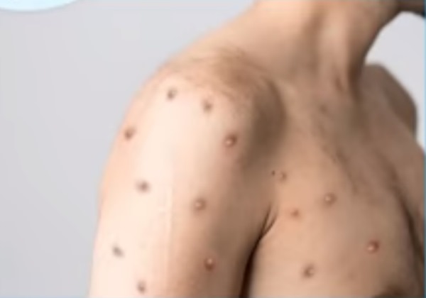  OMS convoca comitê para reavaliar emergência global por mpox